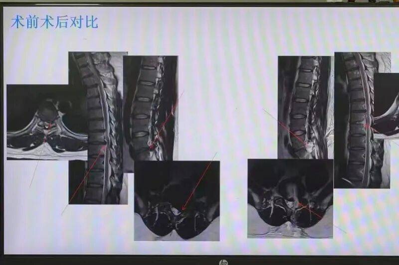 一觉醒来，30岁男子双下肢瘫痪、大小便失禁