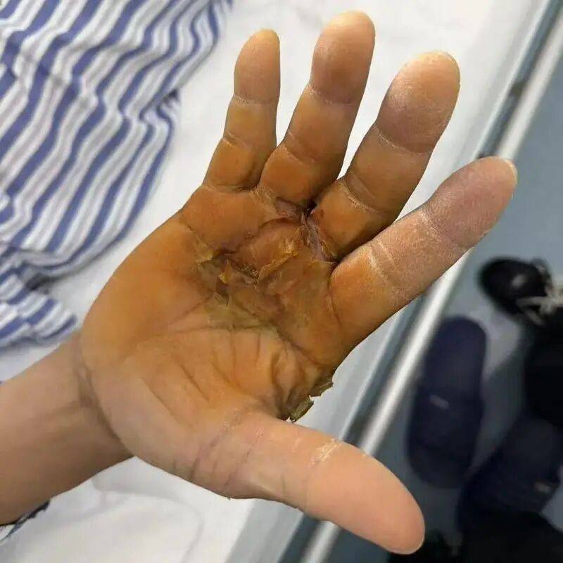 鱼刺扎一下,差点被“吃”掉?医生提醒:72小时不干预,病死率近100% (pic2) 鱼刺扎一下,差点被“吃”掉?医生提醒:72小时不干预,病死率近100% (pic2)