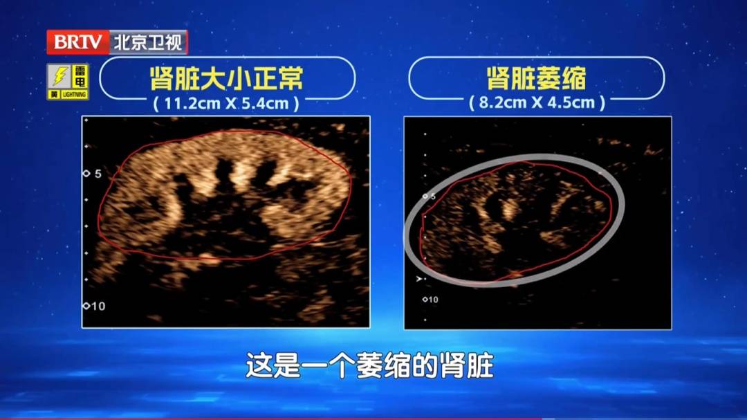 睡觉有这个表现，警惕肾病风险！医生提示：出现3种情况，立即就医 (pic6)